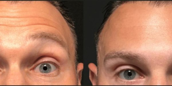 Anti-Wrinkle Injections for men (Botox)
Before & After Images
