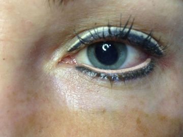Color correction on eyeliner tattoo.