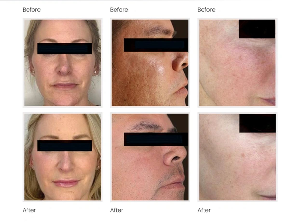 Before and after photos showing improved skin texture and complexion.