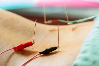 electric stimulation applied to acupuncture needles