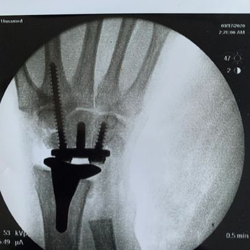 Wrist joint replacement 