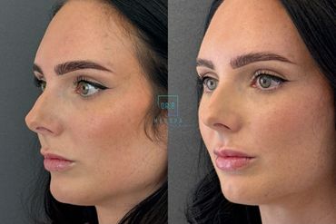 Lip Filler