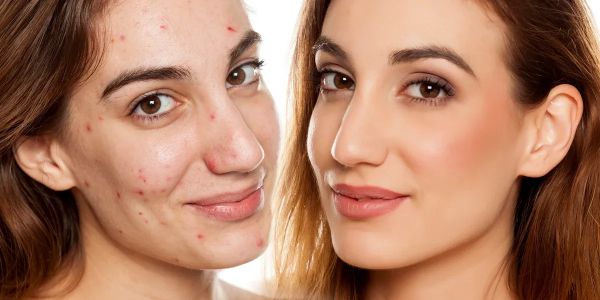 Before and after acne treatment on a woman's face.