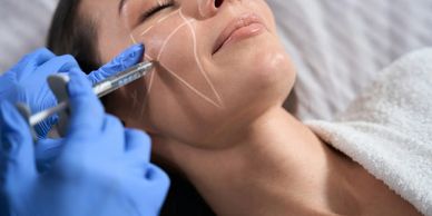 A woman receiving a facial cosmetic injection with marked areas on her cheek.