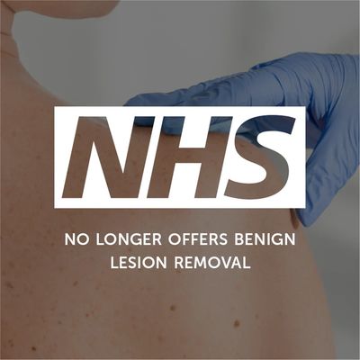 NHS no longer offers benign lesion removal services.