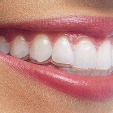 A close-up of a smiling mouth with clear dental aligners.