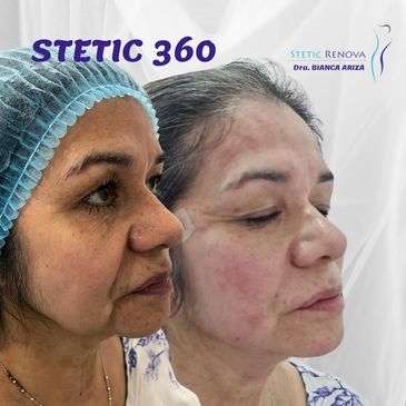 STETIC360 rejuvenecimiento Total sin cirugia