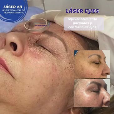 Rejuvenecimiento con laser Co2 Super Pulsado, ultima tecnologia en laser co2 mejoria de la piel,