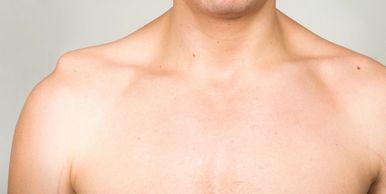 Luxación acromioclavicular