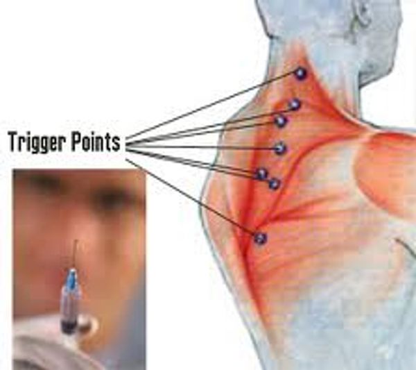 Diagram showing neck trigger points.