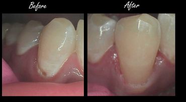 Composite Resotration