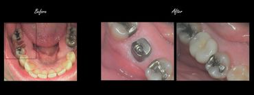 Dental Implant