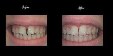 Clear Aligners