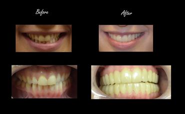 Snap On Smile