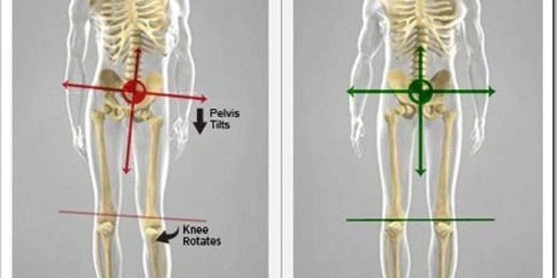 Body Alignment picture of skeleton show how misalignment causes pain. Pain Relief Palm Beach, FL.