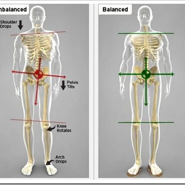 Skeleton  with scoliosis, Rolfing therapy for scoliosis in Palm Beach, within 35 min of zip 33465