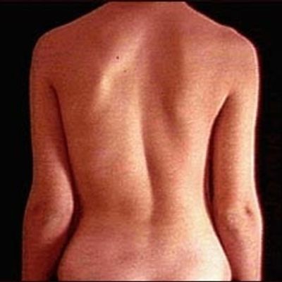 Female back with scoliosis, Rolfing therapy for scoliosis in Palm Beach, within 35 min of zip 33465