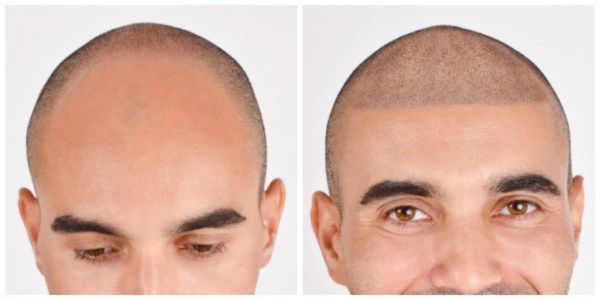 Scalp Micropigmentation for men in white Irish Salon in Clearwater, Tampa Bay, Palm Harbor, Oldsmar
