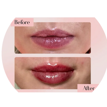 Get rid of fine lines and crow's feet
Natural looking botox filler
Best treatment for acne scars