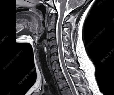 A normal neck MRI scan