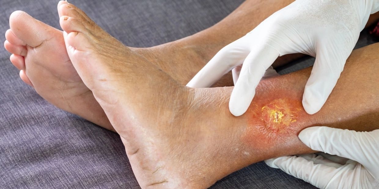 Chronic Wound Treatment