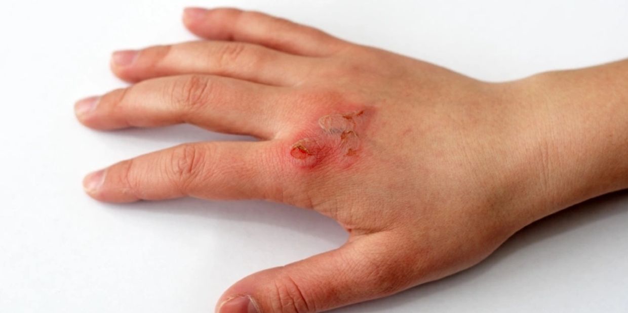 Infectious Wound Treatment