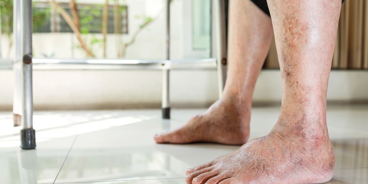 Peripheral Arterial Disease Treatment