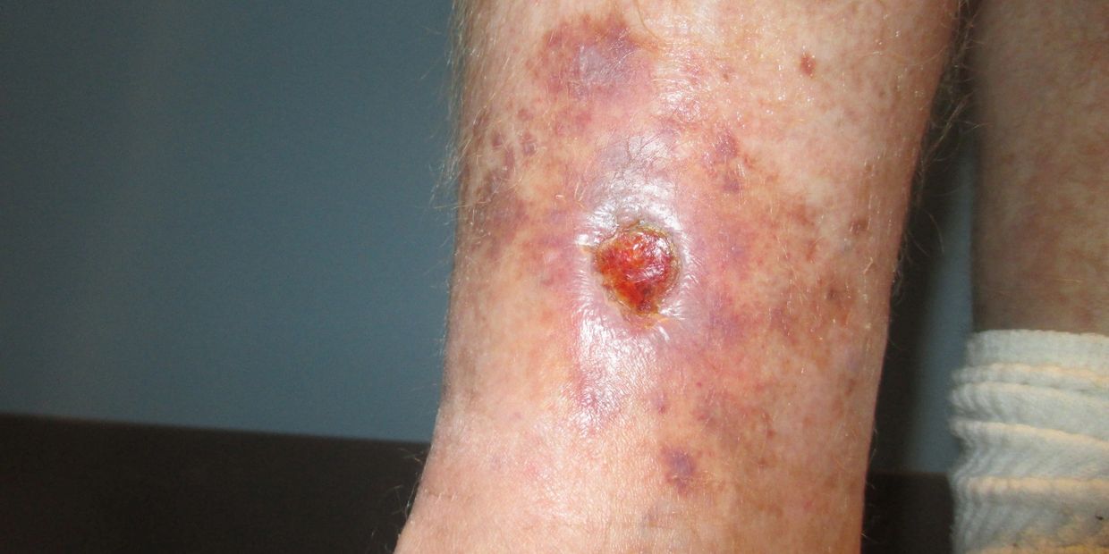 Venous Statis Ulcer Treatment