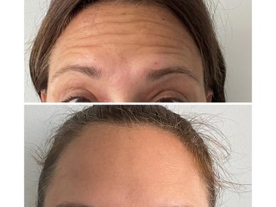 Forehead without wrinkles after a treatment with botox