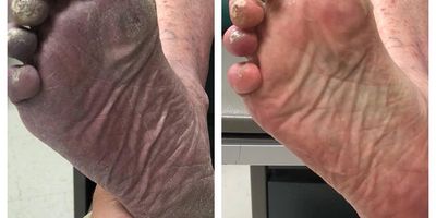 diabetic foot before and after treatment.
