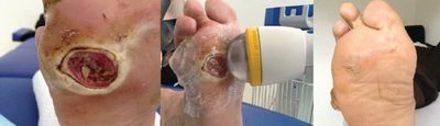 open ulcer before and after shockwave treatment