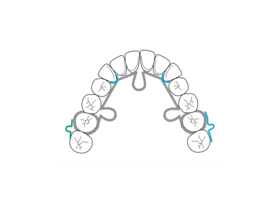 Line drawing of a dental arch with a light-wire appliance