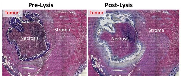 Pre and Post Lysis of Colorectal Cancer FFPE section.  Precise capture of tumor. avoid necrotic area