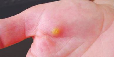 Warts can be removed quickly and easily.