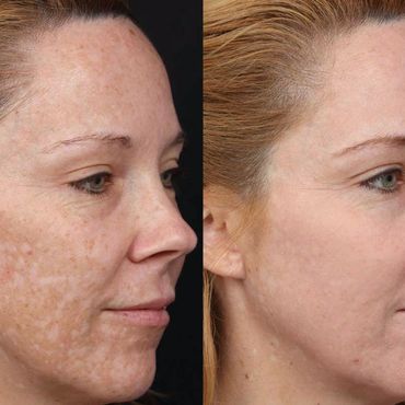 cosmelan peel, pigmentation, pigmentation removal, skin peel, melasma, sun spots,