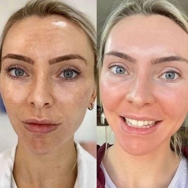 cosmelan peel, pigmentation, pigmentation removal, skin peel, melasma, sun spots,
