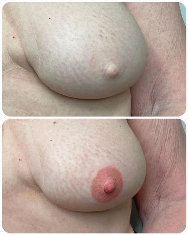 breast cancer, mastectomy, nipple tattoo, scar camouflage, scar revision, 3d nipple, scars