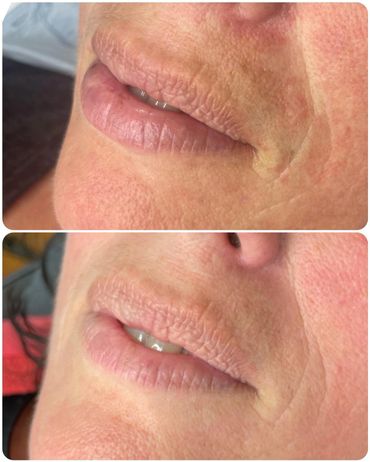 dermal needling, micro needling, derma roller, skin needling