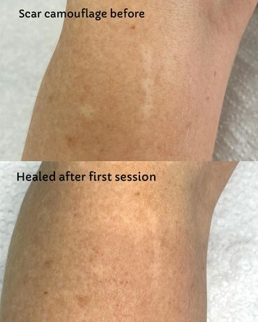 scar camouflage, scar revision, camouflage tattoo, medical tattoo, skin colour tattoo