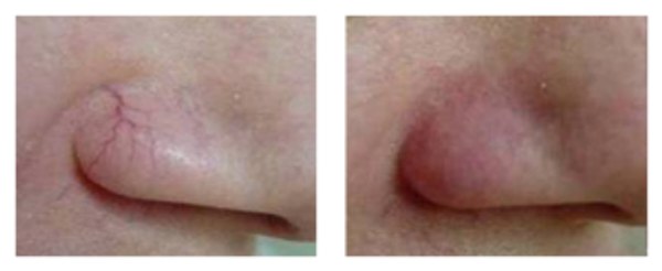 Facial veins removed with Thermo Clear