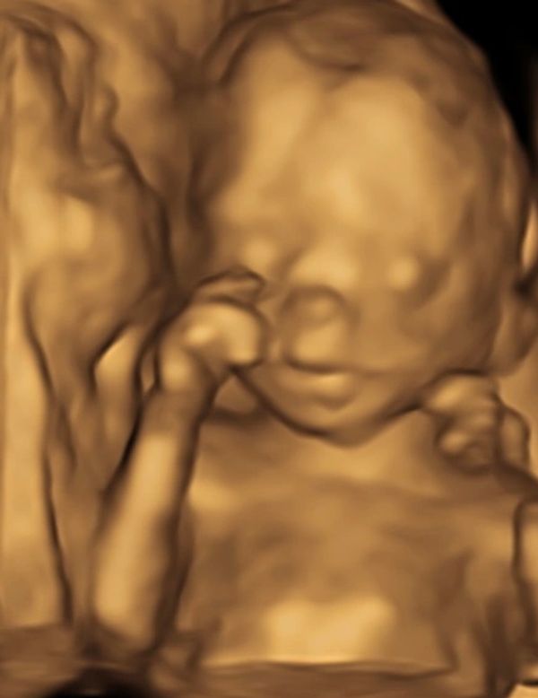 17 weeks
3D ultrasound