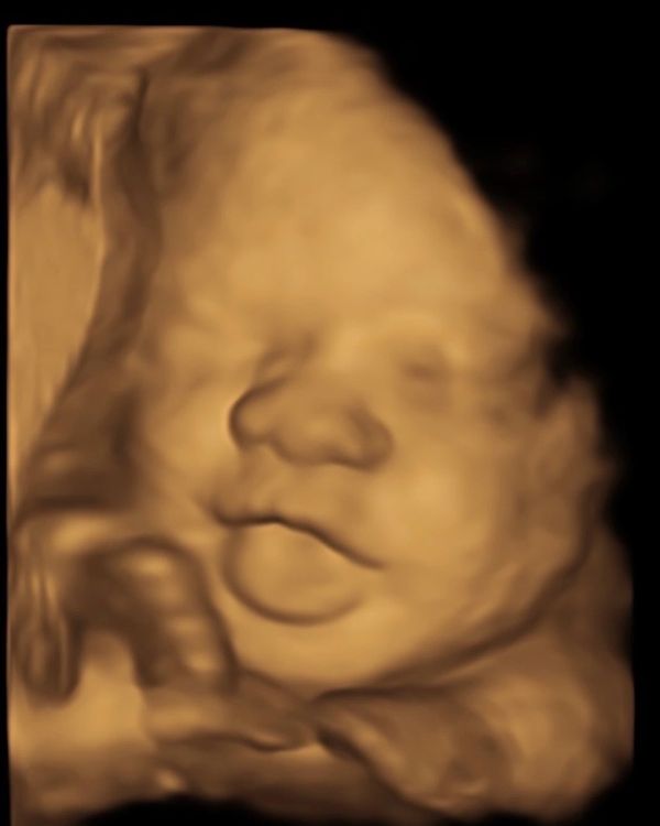 happy baby
3D and 4D ultrasound image