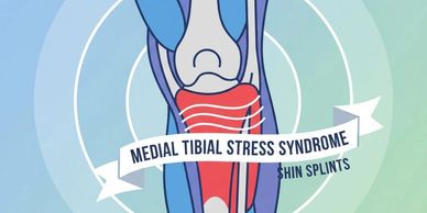Illustration of medial tibial stress syndrome or shin splints.