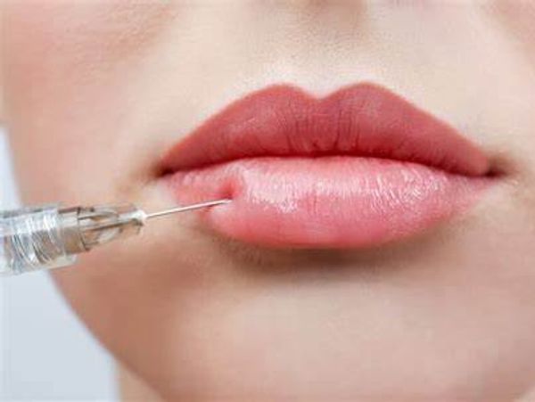Close up shot of a lip filler treatment