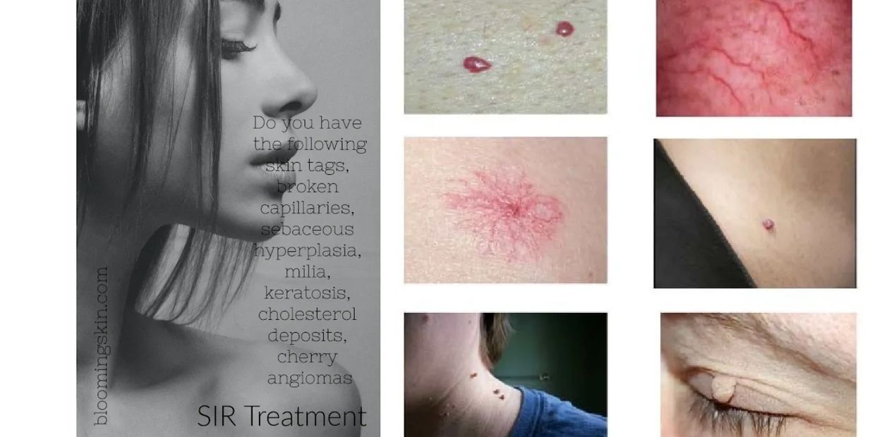 skin tags capillaries telangiectasias milia cherry angiomas keratosis sebaceous hyperplasia DPN