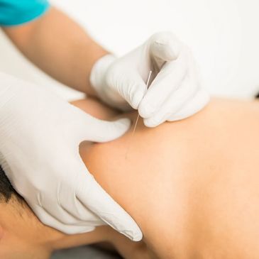 Dry Needling upper trapezius https://abracupuncture.com/contact