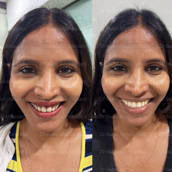 Smile Makeovers
Dental Implants
Full Mouth Rehabilitation
Veneers
Full Mouth Implants
Invisalign / C
