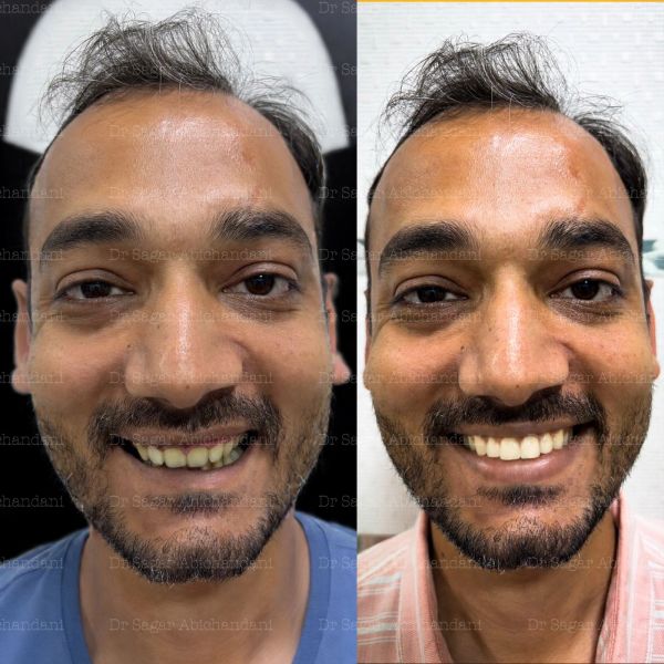 See selected cases treated at The Dental Hub Mumbai, including veneers, smile makeovers, dental impl