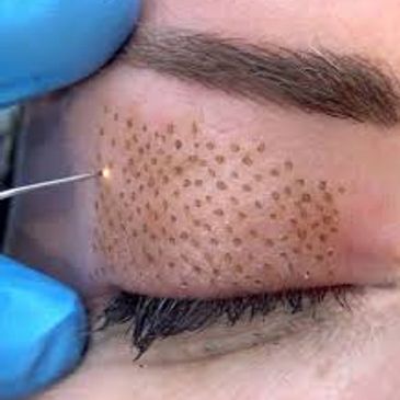 Plasma fibroblast course