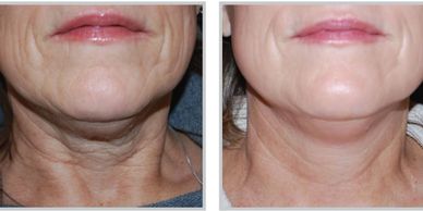 Lutronic Neck before and after